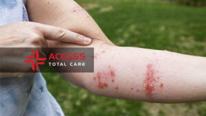 woman holding arm infected by poison ivy, urgent care services